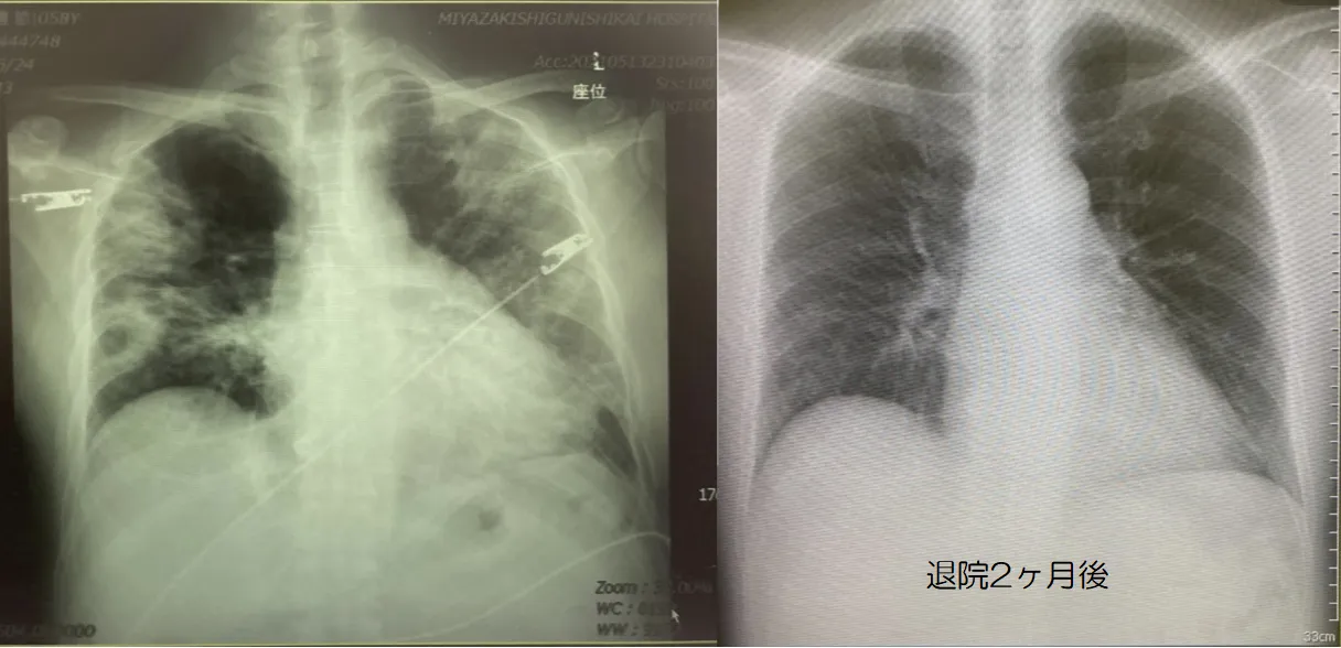 新型コロナ後の肺の状態